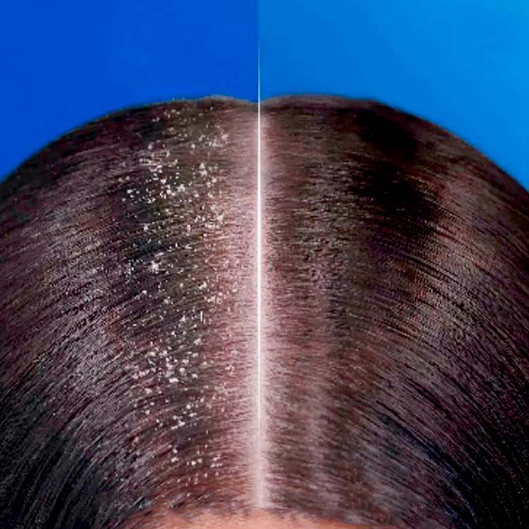 Shampoo / Conditioner Anti-dandruff 400 ml